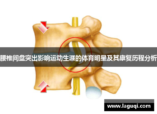 腰椎间盘突出影响运动生涯的体育明星及其康复历程分析